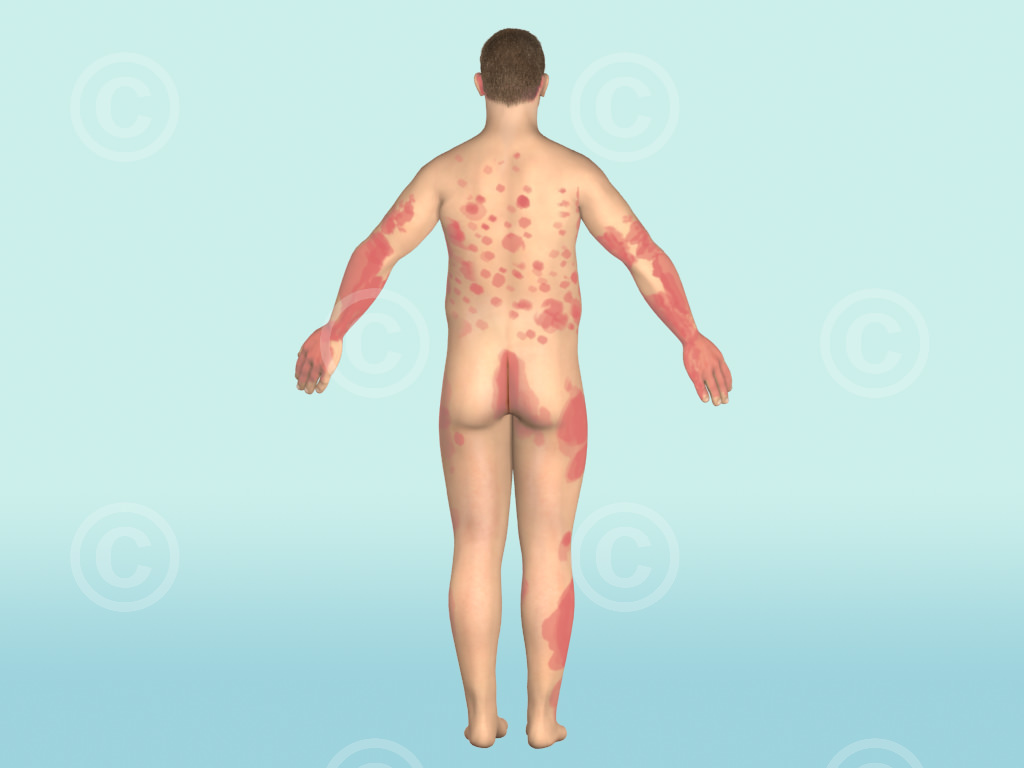Hautbereiche-psoriasis-diagnose