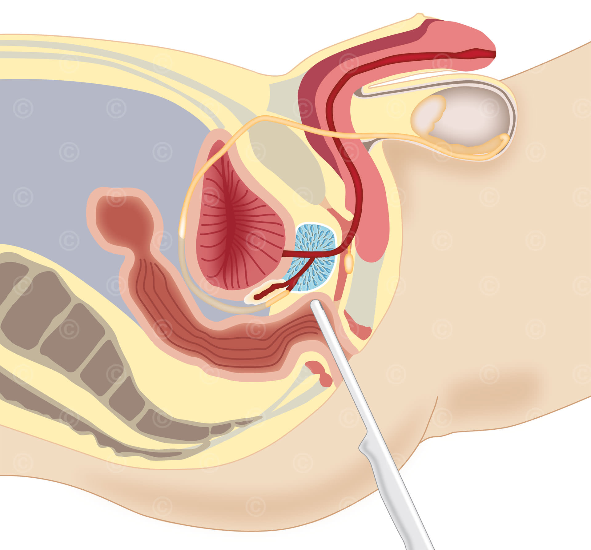 prostata-ultraschall