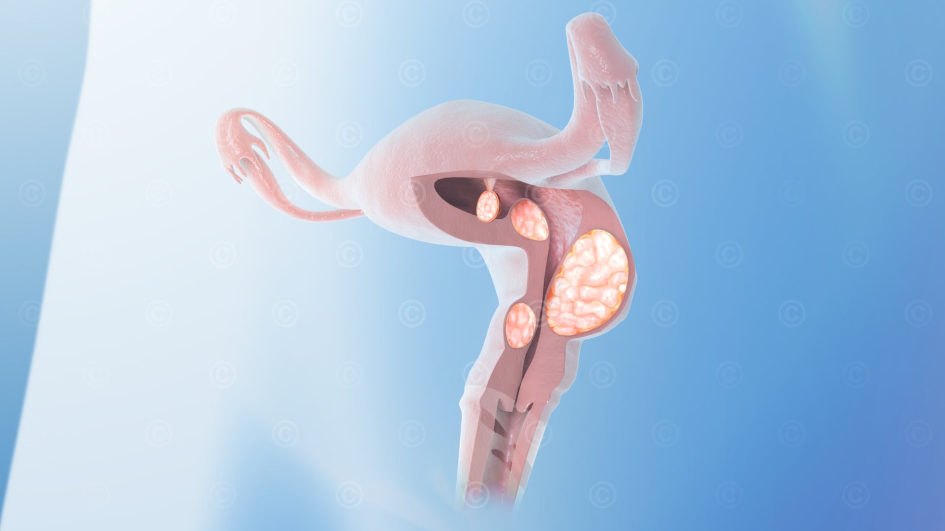 Uterus Myome