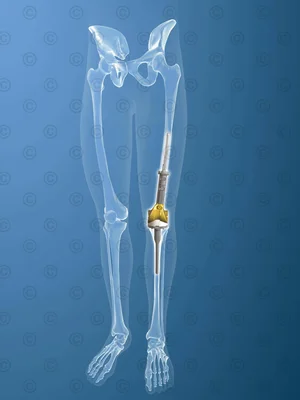 Implantat Knie